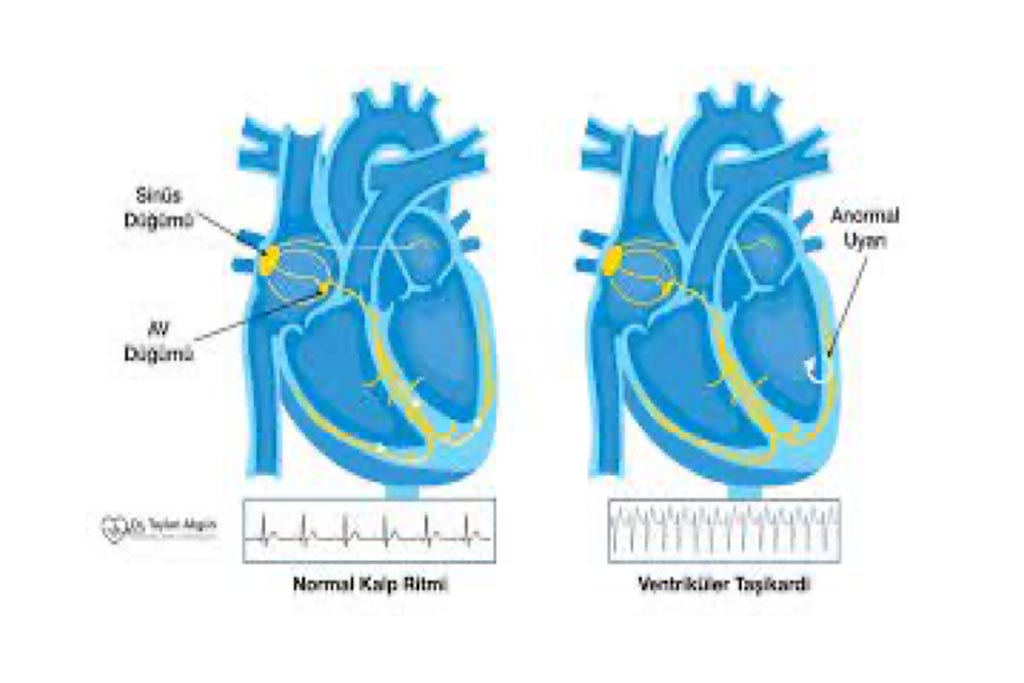 Ventricular Tachycardia Ablation